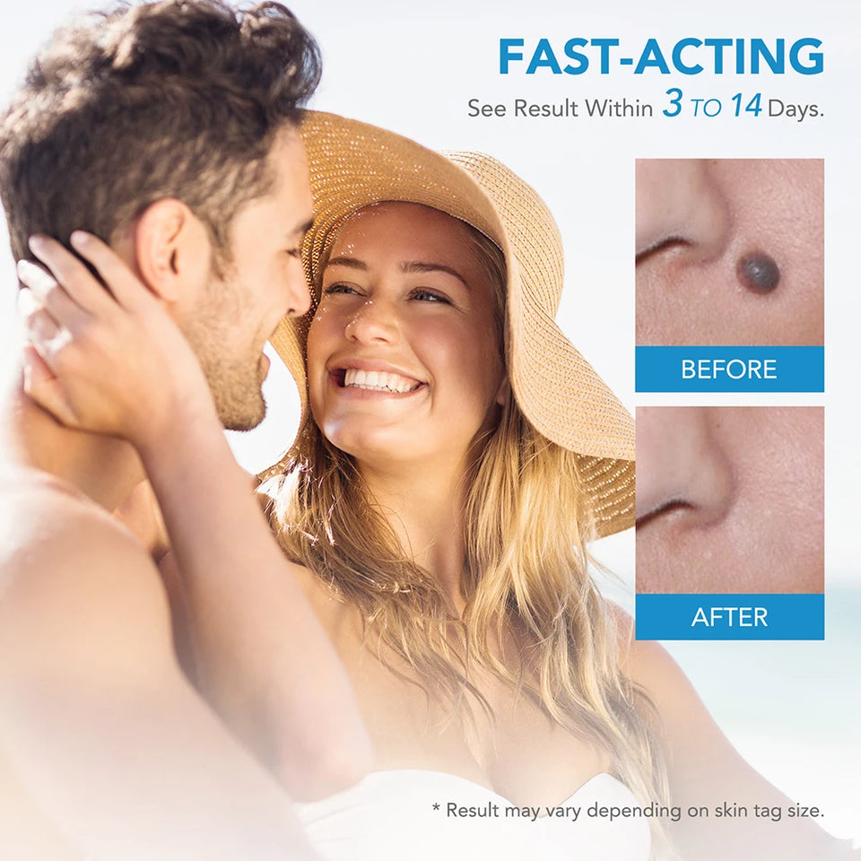 TagBuddy Kit - No More Skin Tags
